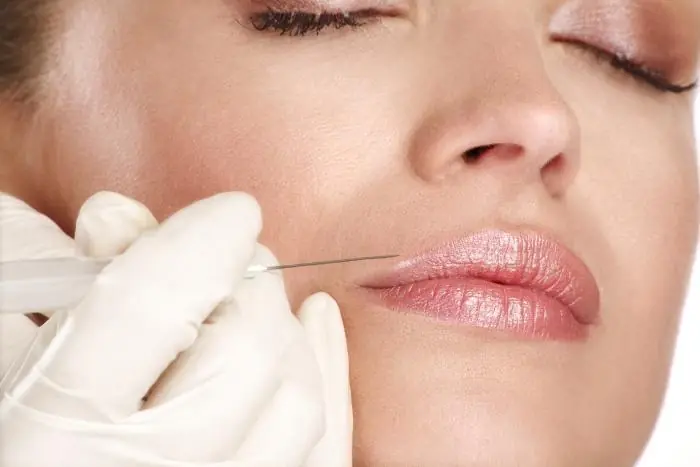 Preenchimento labial com ácido hialurônico
