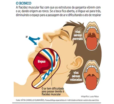 Esquema das vias aéreas no ronco e na apneia